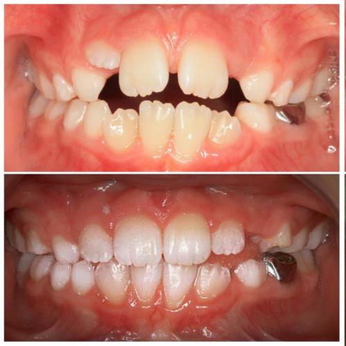 Early Treatment included an expander to create space for permanent teeth